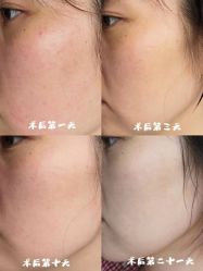 体验后-伊美尔医疗美容医院