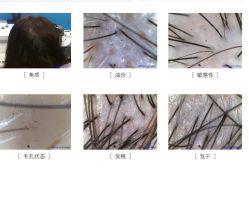 体验前-大麦微针植发全国连锁