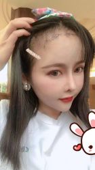 点击看大图 -大麦微针植发丨全国连锁