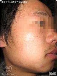 -韩医生专业祛痘连锁机构