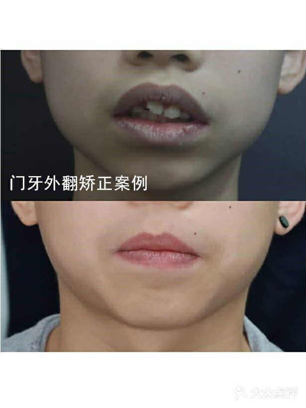 门牙外翻矫正案例