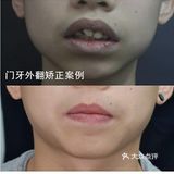门牙外翻矫正案例