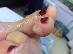 点击看大图 -德哥灰指甲脚气甲沟炎跖疣护理