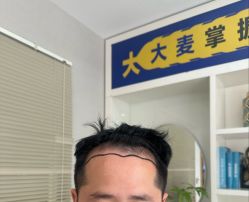 -大麦微针植发丨全国连锁