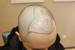 -大麦微针植发丨全国连锁