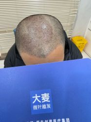 -大麦微针植发丨全国连锁