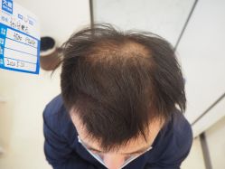 -大麦微针植发丨全国连锁