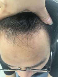 -大麦微针植发全国连锁