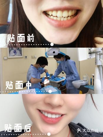 【牙齿美白】和你的黄牙说拜拜