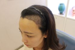 -大麦微针植发丨全国连锁