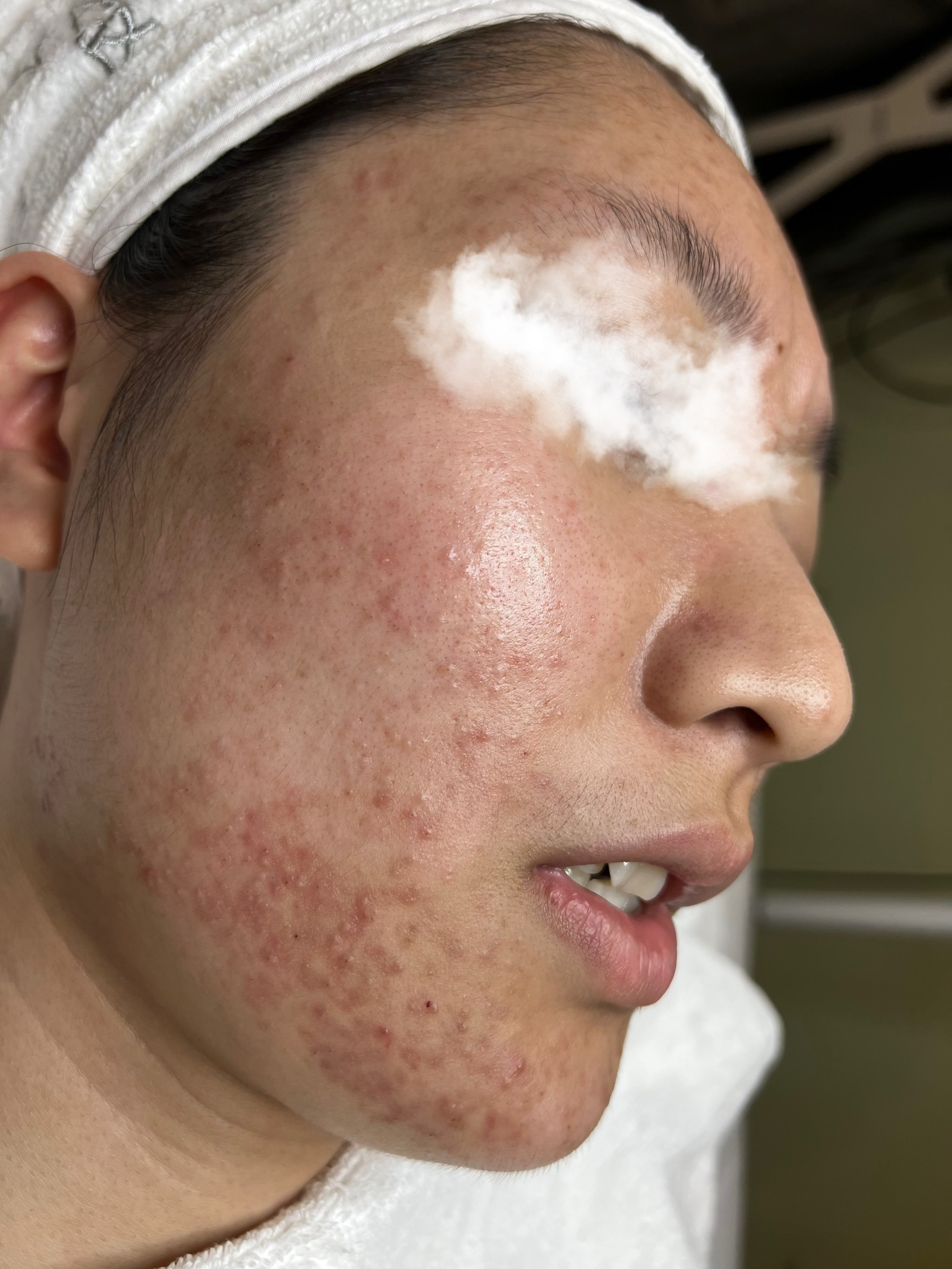 28天痘痘闭口全消了!