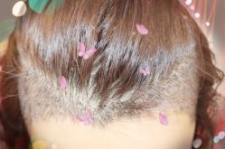 -大麦微针植发全国连锁