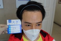 -大麦微针植发丨全国连锁