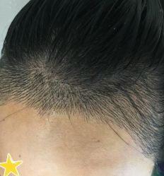 -大麦微针植发丨全国连锁