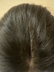 -碧莲盛·不剃发植发