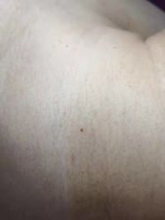 -美人痣全国连锁
