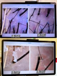 -润复丝·泽发防脱头皮管理