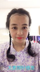 点击看大图 -大麦微针植发丨全国连锁