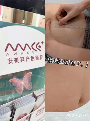 ten 妊娠纹终于被修复啦！