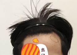 -大麦微针植发全国连锁