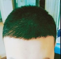 -大麦微针植发丨全国连锁