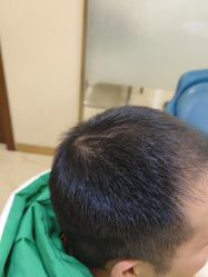 -碧莲盛·不剃发植发