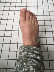 铭甲科技灰指甲-EPAI·灰指甲·甲沟炎·嵌甲护理