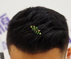 -大麦微针植发全国连锁