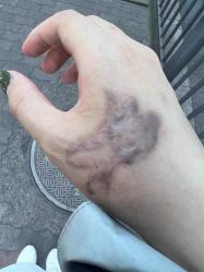 -一次性洗纹身·修复疤痕·超皮秒