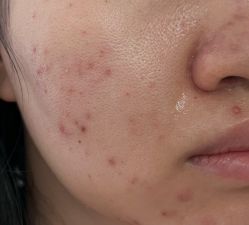 -苗方清颜痘肌研究所