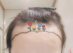 -大麦微针植发全国连锁