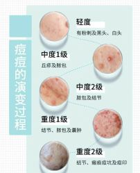 -靓芙泉专研痘痘肌