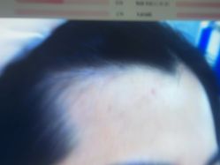 体验前-雍禾植发全国连锁