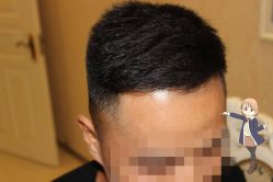 -大麦微针植发丨全国连锁