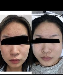 -悟空祛痘·诺奖技术专业店