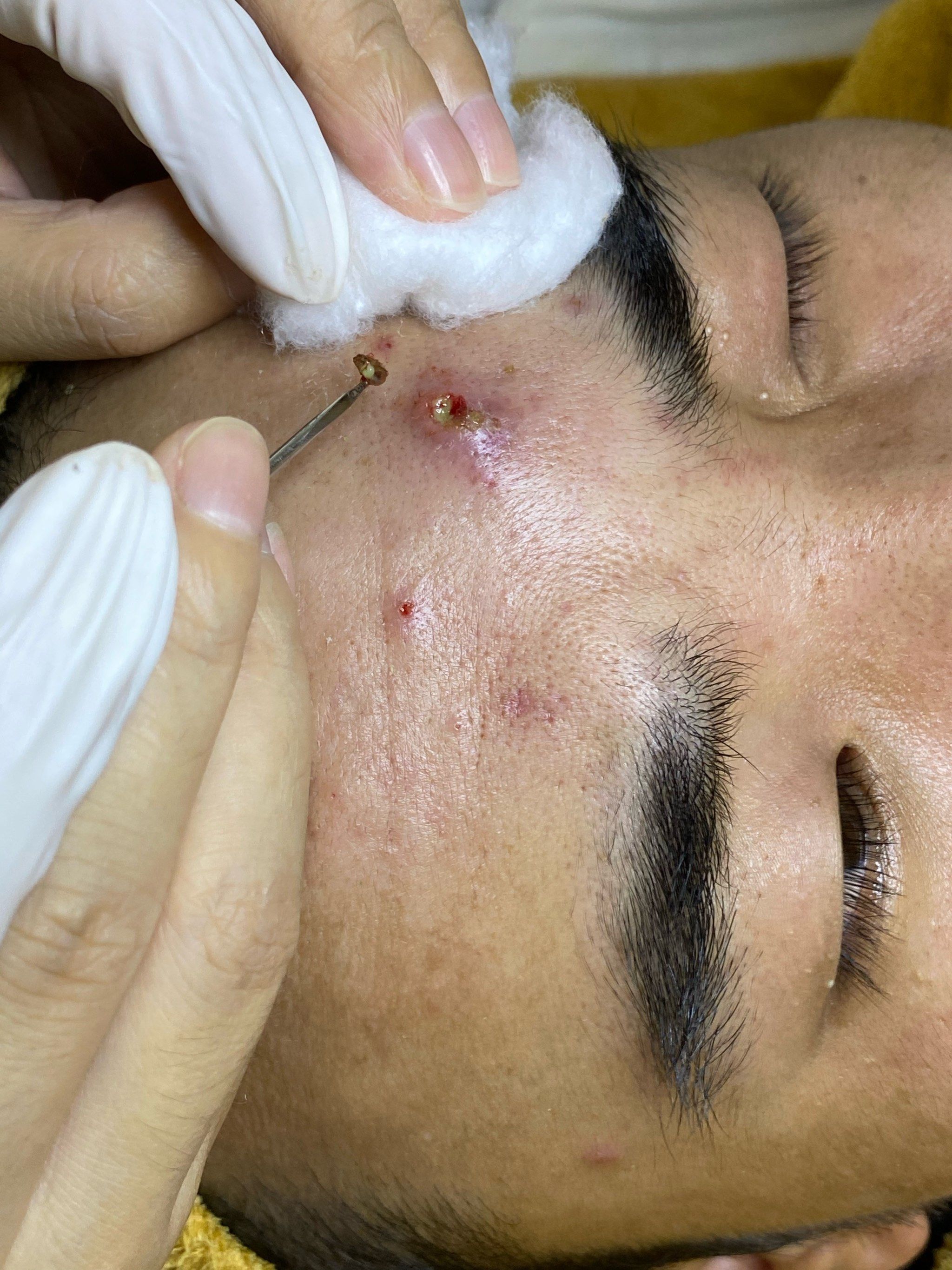 长痘能清吗?脓胞囊肿看过来!