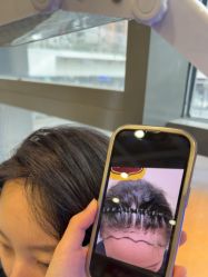 -碧莲盛·不剃发植发