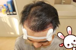 点击看大图 -大麦微针植发丨全国连锁