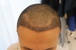 -大麦微针植发丨全国连锁