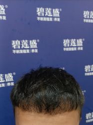 -碧莲盛·不剃发植发