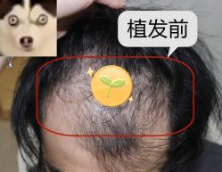 -大麦微针植发全国连锁