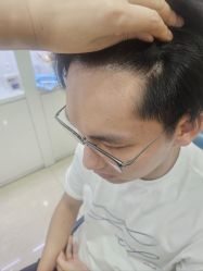 -大麦微针植发全国连锁