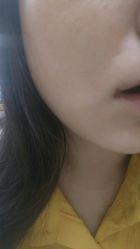 点击看大图 脸上疤-美莱医学美容医院