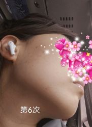 体验后-坤如玛丽·医疗美容中心