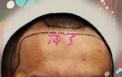 -大麦微针植发全国连锁