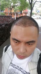 点击看大图 -大麦微针植发丨全国连锁