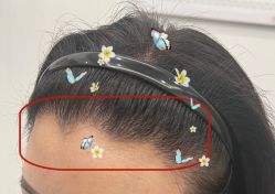 -大麦微针植发全国连锁