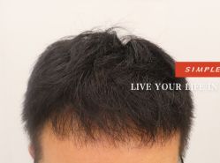 -大麦微针植发全国连锁