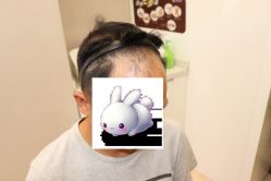 -大麦微针植发丨全国连锁