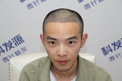 点击看大图 -大麦微针植发丨全国连锁